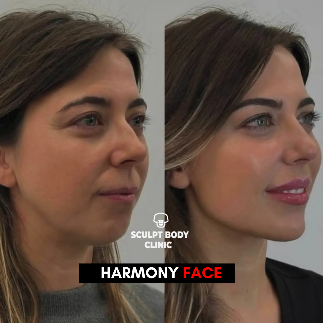 Harmony Face 4